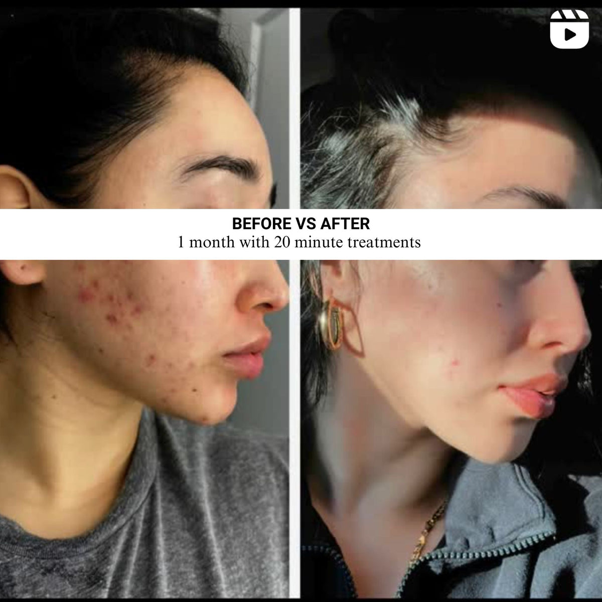 Lumara Viso Red Light Therapy Face Mask | 470 LED Facial Skincare Device