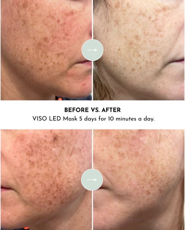 Lumara Viso Red Light Therapy Face Mask | 470 LED Facial Skincare Device